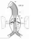 Fig. 04 - Endovascular prosthesis, system and method