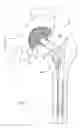 Fig. 02 - Bimetal acetabular component construct for hip joint prosthesis