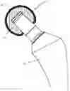 Fig. 01 - Coated joint endoprosthesis