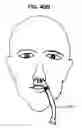 Fig. 22 - Nasal gas delivery system and method for use thereof