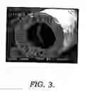 Fig. 04 - Method of making and using a hollow fiber microfiltration membrane