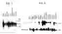 Fig. 04 - DLC-1 gene deleted in cancers