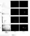 Fig. 04 - Differentially expressed genes in prostate cancer