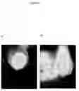 Fig. 11 - Tumour suppressor gene