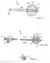 Fig. 04 - Drug eluting brachytherapy methods and apparatus