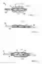 Fig. 05 - Drug eluting brachytherapy methods and apparatus