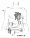Fig. 08 - Dual inlet mixed-flow blood pump