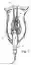 Fig. 02 - Urethral sling introducer and method of use
