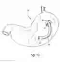 Fig. 12 - Methods and devices for diagnostic and therapeutic interventions in the peritoneal cavity