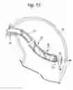 Fig. 13 - Methods and devices for diagnostic and therapeutic interventions in the peritoneal cavity