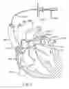 Fig. 06 - Methods of catheterization using a dual steer preshaped catheter