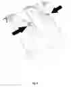 Fig. 05 - Cervical traction device