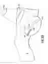 Fig. 18 - Occludable intravascular catheter for drug delivery and method of using the same