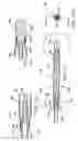 Fig. 55 - Occludable intravascular catheter for drug delivery and method of using the same