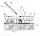 Fig. 01 - Method for inserting solid object into skin