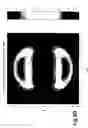 Fig. 10 - Method and apparatus for controlling ablation in refractive surgery