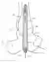 Fig. 01 - Intramedullary locked compression screw for stabiliziation and union of complex ankle and subtalar deformities