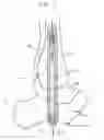 Fig. 02 - Intramedullary locked compression screw for stabiliziation and union of complex ankle and subtalar deformities
