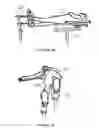 Fig. 02 - Surgical intramedullary implant with improved locking for fixation of fractured bone segments