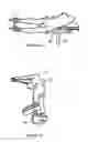Fig. 03 - Surgical intramedullary implant with improved locking for fixation of fractured bone segments