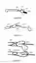 Fig. 04 - Surgical intramedullary implant with improved locking for fixation of fractured bone segments