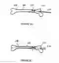 Fig. 05 - Surgical intramedullary implant with improved locking for fixation of fractured bone segments