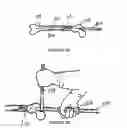 Fig. 07 - Surgical intramedullary implant with improved locking for fixation of fractured bone segments