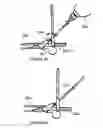 Fig. 08 - Surgical intramedullary implant with improved locking for fixation of fractured bone segments