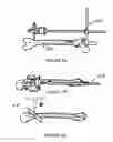 Fig. 09 - Surgical intramedullary implant with improved locking for fixation of fractured bone segments