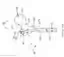 Fig. 12 - Surgical intramedullary implant with improved locking for fixation of fractured bone segments