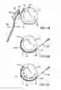 Fig. 04 - Devices and methods for heart valve repair