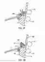 Fig. 06 - Devices and methods for heart valve repair