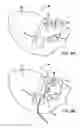 Fig. 08 - Devices and methods for heart valve repair