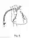 Fig. 07 - Dynamic cannula