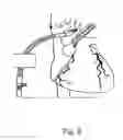Fig. 08 - Dynamic cannula