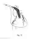 Fig. 09 - Dynamic cannula