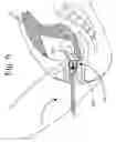 Fig. 07 - Vaginal delineation and occlusion device