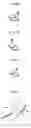 Fig. 06 - Surgical method for mandibular angle fracture operation and devices therefor