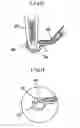 Fig. 07 - Surgical method for mandibular angle fracture operation and devices therefor
