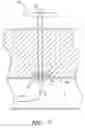 Fig. 07 - Vascular wound closure device and method