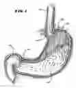 Fig. 02 - Methods for treating the cardia of the stomach