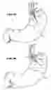 Fig. 12 - Methods for treating the cardia of the stomach