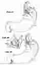 Fig. 13 - Methods for treating the cardia of the stomach