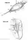 Fig. 15 - Methods for treating the cardia of the stomach