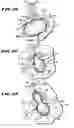 Fig. 16 - Methods for treating the cardia of the stomach