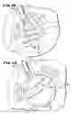 Fig. 20 - Methods for treating the cardia of the stomach