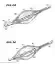 Fig. 25 - Methods for treating the cardia of the stomach