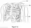 Fig. 04 - Subcutaneous cardiac rhythm management with disordered breathing detection and treatment