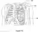 Fig. 05 - Subcutaneous cardiac rhythm management with disordered breathing detection and treatment