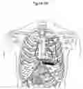 Fig. 07 - Subcutaneous cardiac rhythm management with disordered breathing detection and treatment